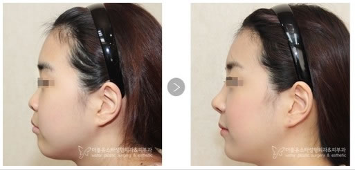 韩国W-star整形外科医院鼻部整形手术对比案例