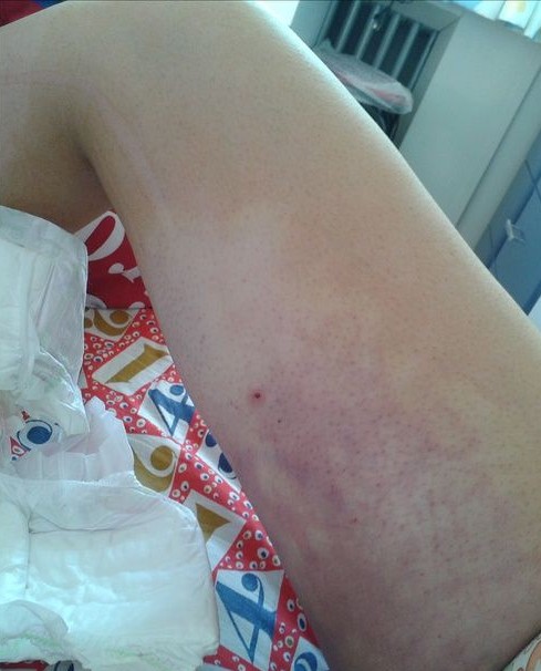 想做吸脂减肥的速度围观啦……献上吸脂瘦腿经历~~~