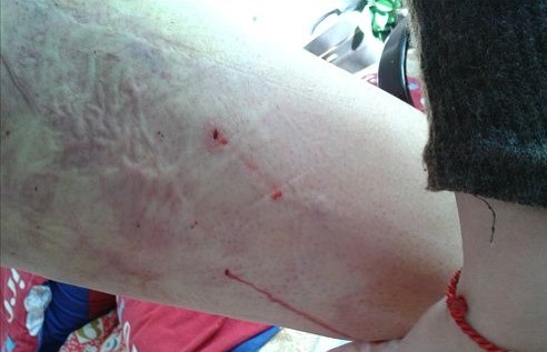 想做吸脂减肥的速度围观啦……献上吸脂瘦腿经历~~~