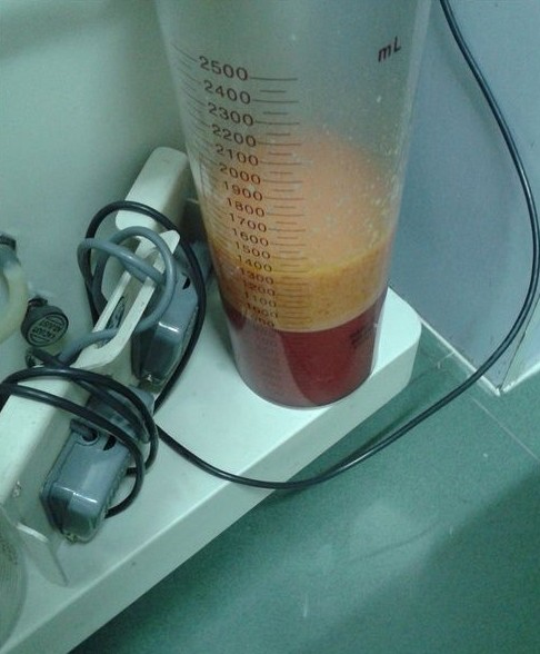 想做吸脂减肥的速度围观啦……献上吸脂瘦腿经历~~~