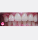全瓷牙