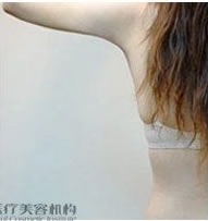 手臂聚能紧致溶脂减肥前后对比照