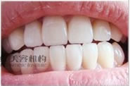 牙齿3D美容冠前后对比照