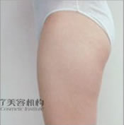 臀部/大腿聚能紧致溶脂减肥前后对比照