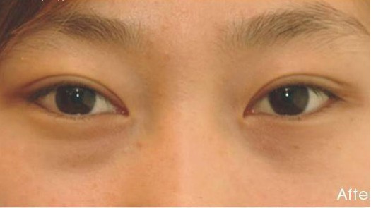 无痕双眼皮手术前后对比图