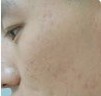 激光去痘印对比案例