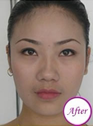 注射瘦脸前后对比图