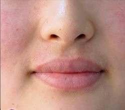 激光脱唇毛对比案例