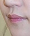 厚唇改薄整形前后对比