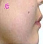 注射丰面颊前后对比照