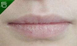 厚唇变薄案例