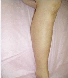 腿部脱毛对比案例