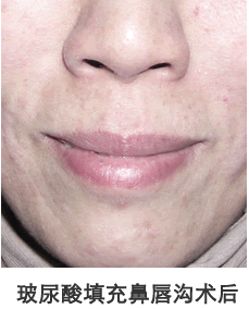 玻尿酸填充鼻唇沟前后对比