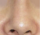 北京清木鼻部畸形矫正对比图