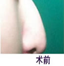 北京清木鼻翼整形前后对比图