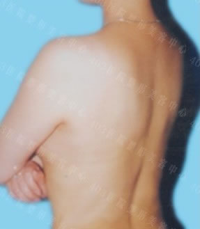 背部吸脂前后对比图