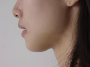 隆下颌手术对比图