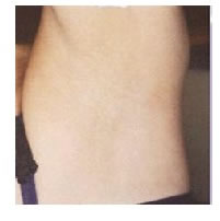 激光脱腋毛前后对比图片