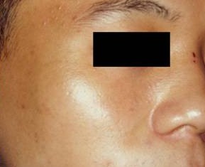 太田痣美容前后对比