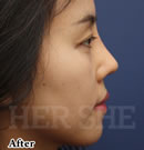 鼻部综合整形对比案例