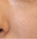 皮肤改善与毛孔缩小前后对比照片