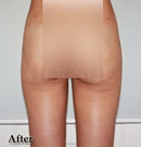 臀部、大腿吸脂术前后对比照片