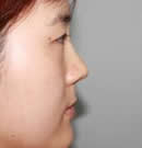鼻部整形手术前后对比照片
