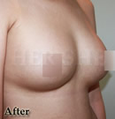 无手术无痛症的丰胸整形前后对比照片