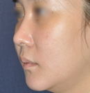 韩国4月31日整形外科短鼻矫正对比照片