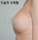 移植果冻义乳整形术前后对比照片