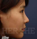 line鼻部整形对比案例