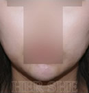 注射玻尿酸瘦下巴前后对比照片