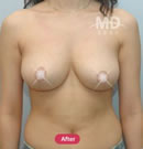 韩国MD整形外科胸部下垂矫正术对比案例