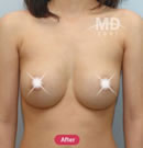 乳房下垂矫正手术前后对比照片