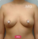 韩国MD整形外科巨乳缩小+乳晕改小对比案例