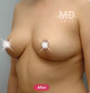 韩国MD整形外科巨乳缩小术+乳晕缩小术对比案例