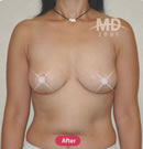 韩国MD整形外科乳房下垂矫正术对比案例