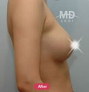 假体隆胸术前后对比照片