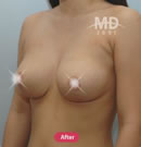 韩国MD整形外科巨乳缩小与乳晕缩小对比案例