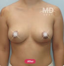 韩国MD整形外科假体隆胸+乳晕缩小+乳房下垂矫正对比案例