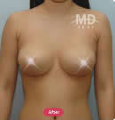 胸部整形手术前后案例对比照片