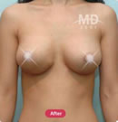 乳房畸形矫正整形手术前后对比照片