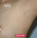 韩国MD整形外科胸部整形疤痕情况对比案例