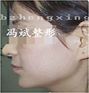 面部吸脂手术案例