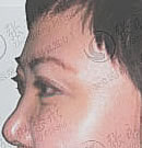 保妥适注射祛除鱼尾纹效果对比图