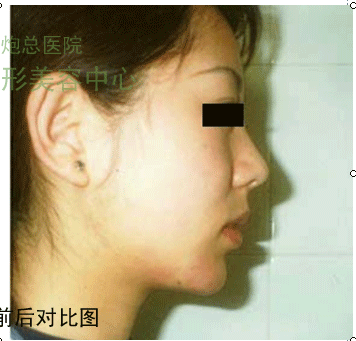隆下颌前后对比图