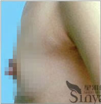 美国麦格假体隆胸前后对比照