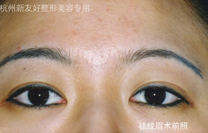 祛纹眉
