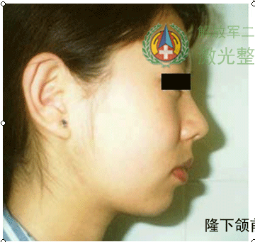 隆下颌前后对比图