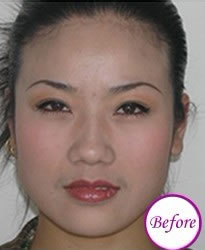 注射瘦脸前后对比图